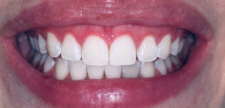 بعد تبيض-ليزر 2